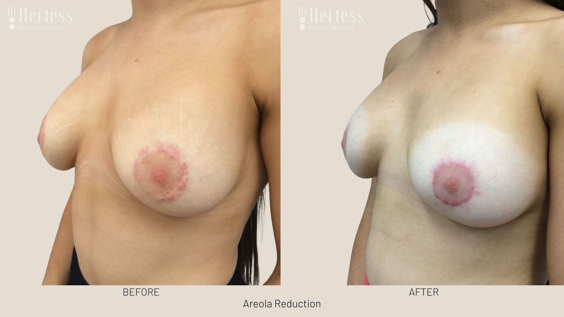 areola reduction