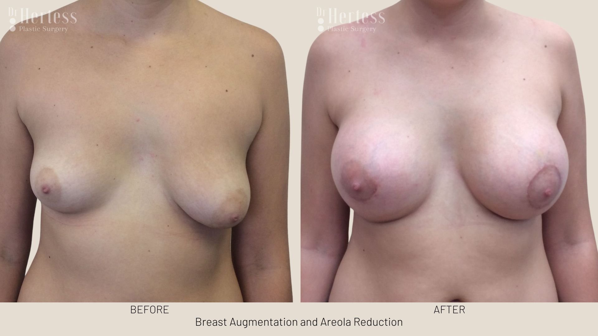 areola reduction