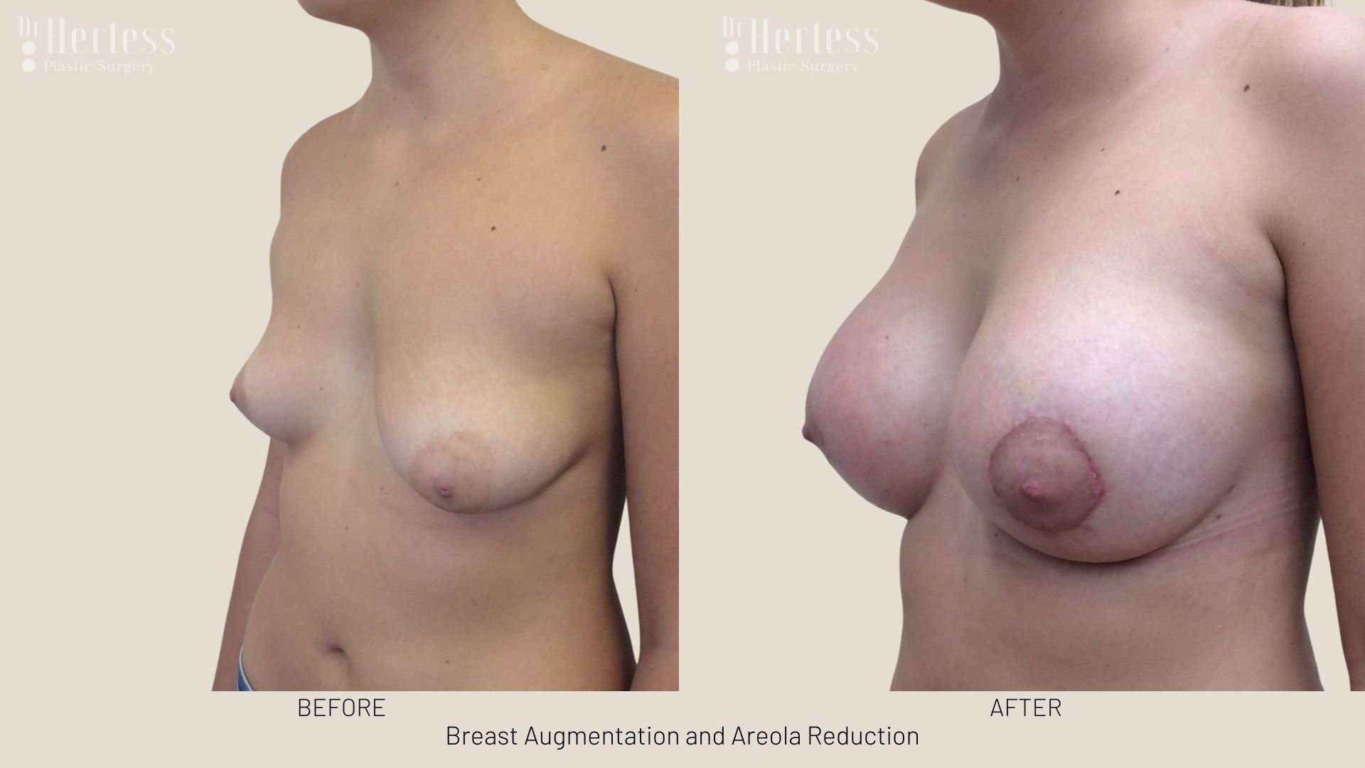 areola reduction