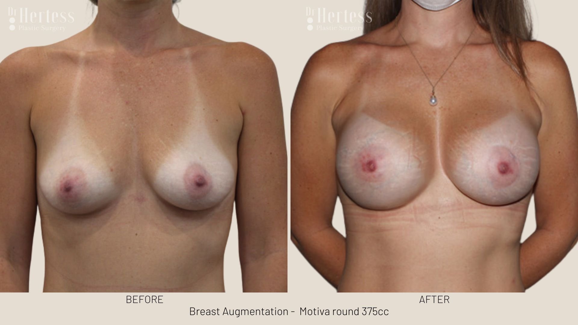 breast augmentation before and after