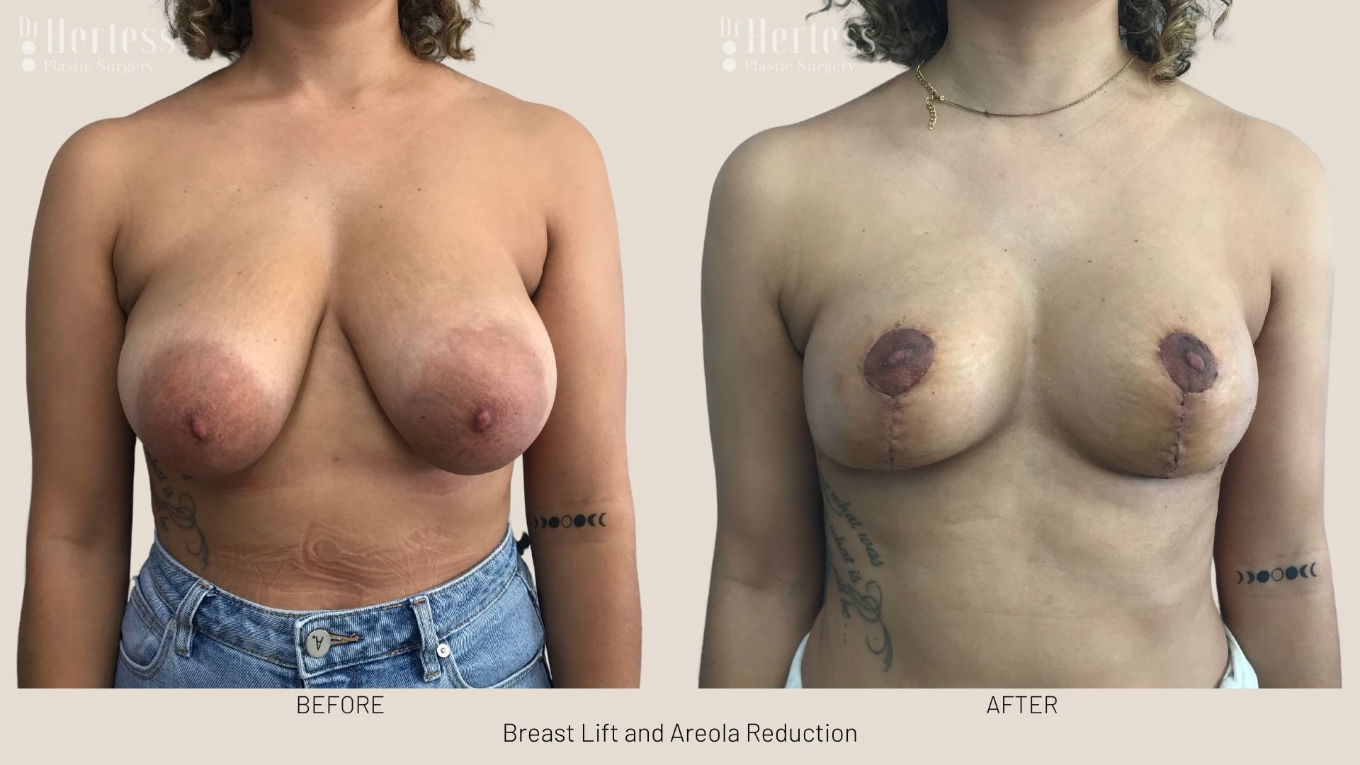 areola reduction