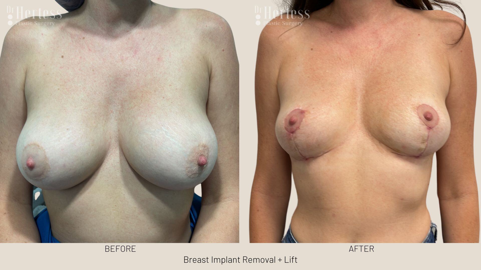 breast implant removal and lift before and after