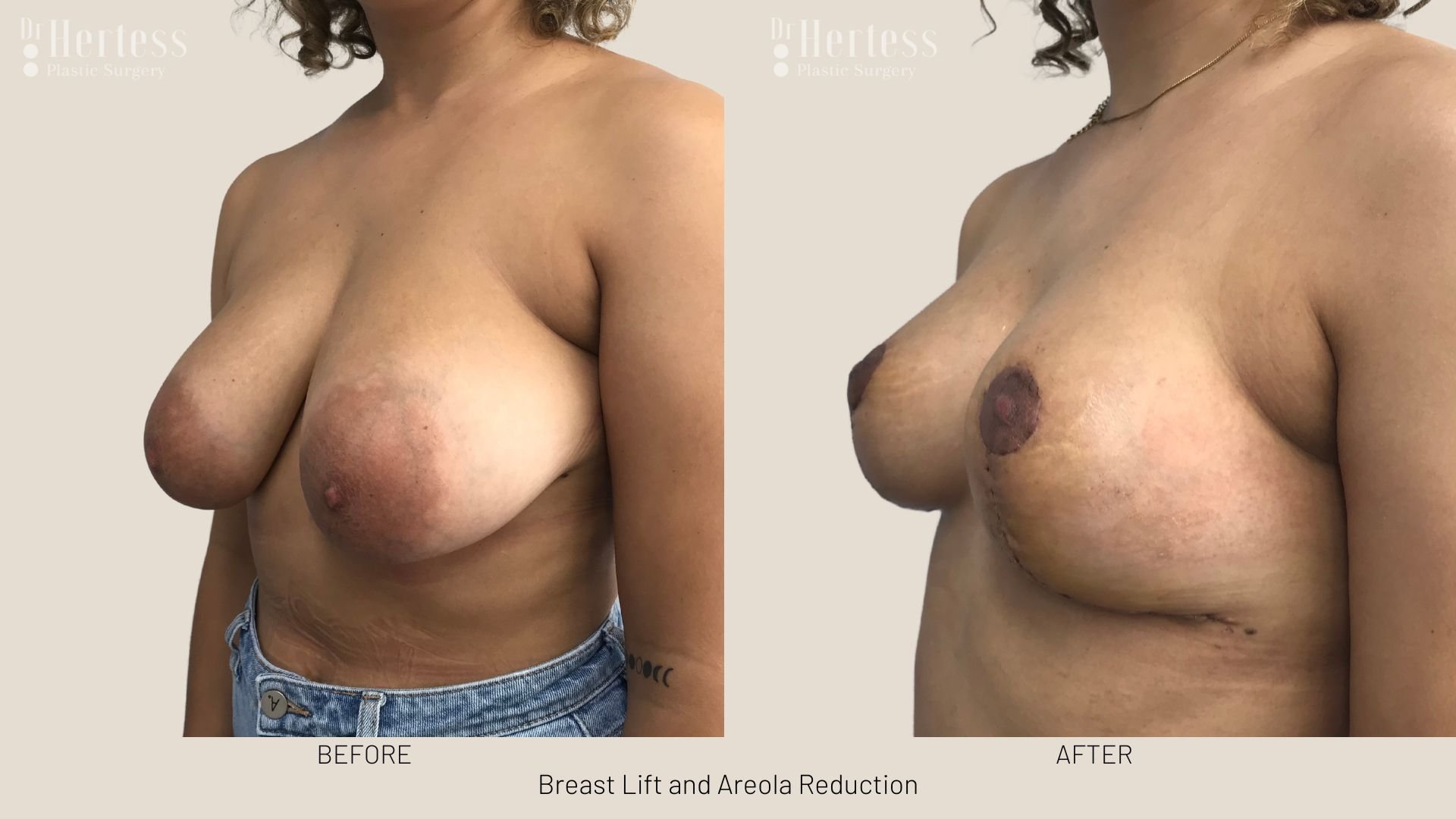 areola reduction