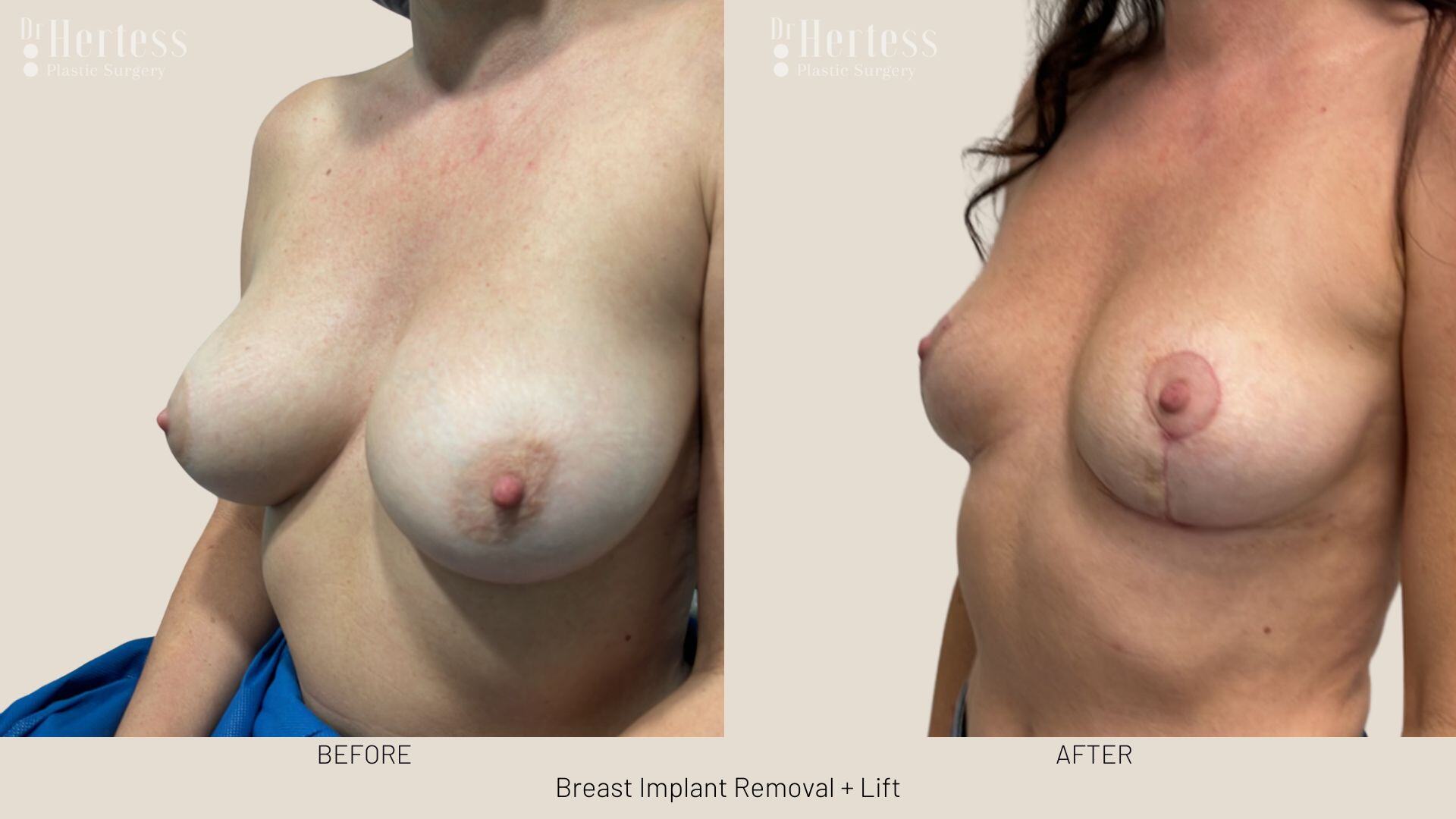 breast implant removal and lift before and after