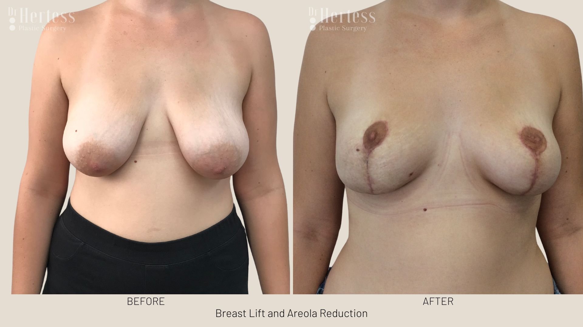 areola reduction