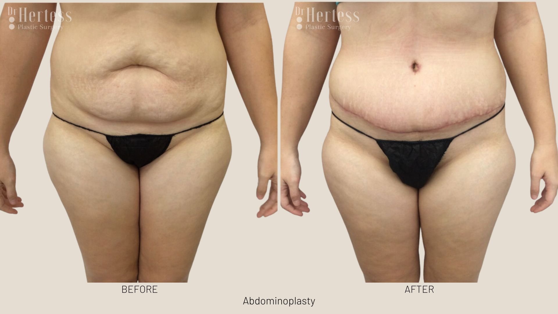 tummy tuck scars before and after