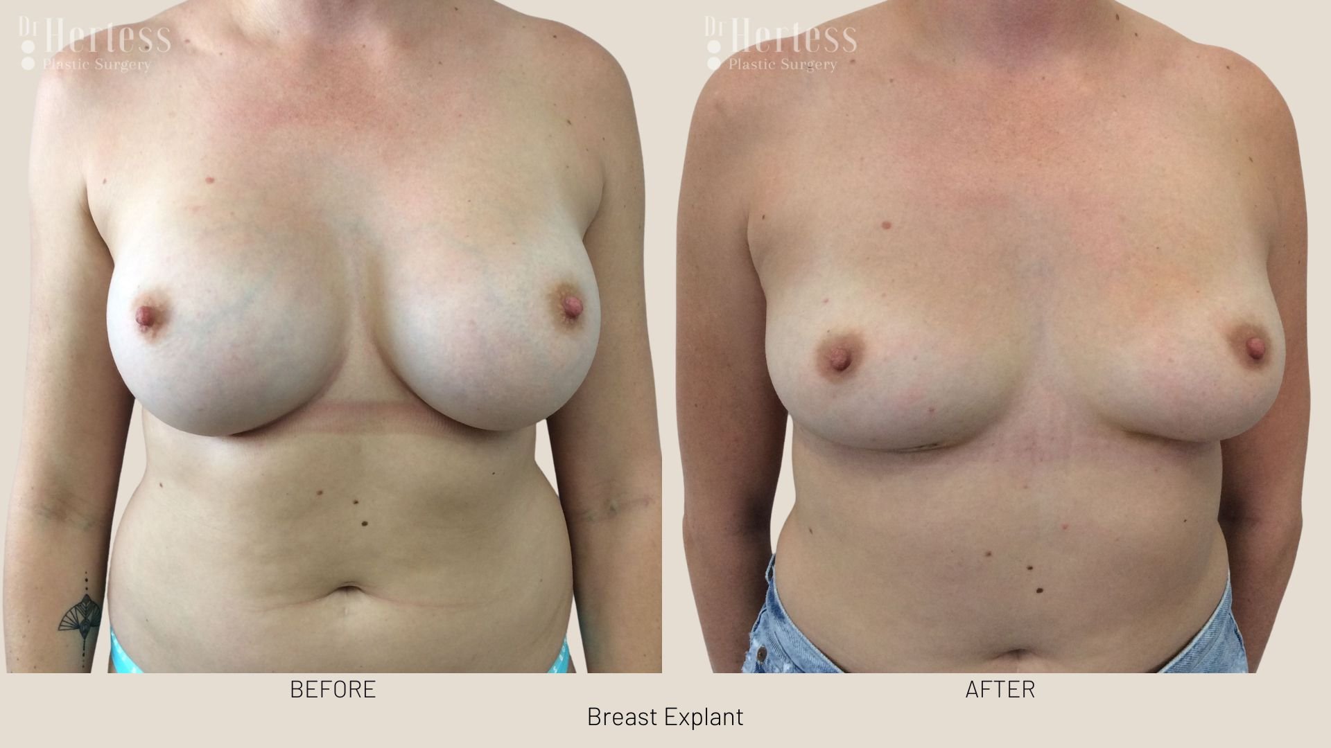 breast implant removal