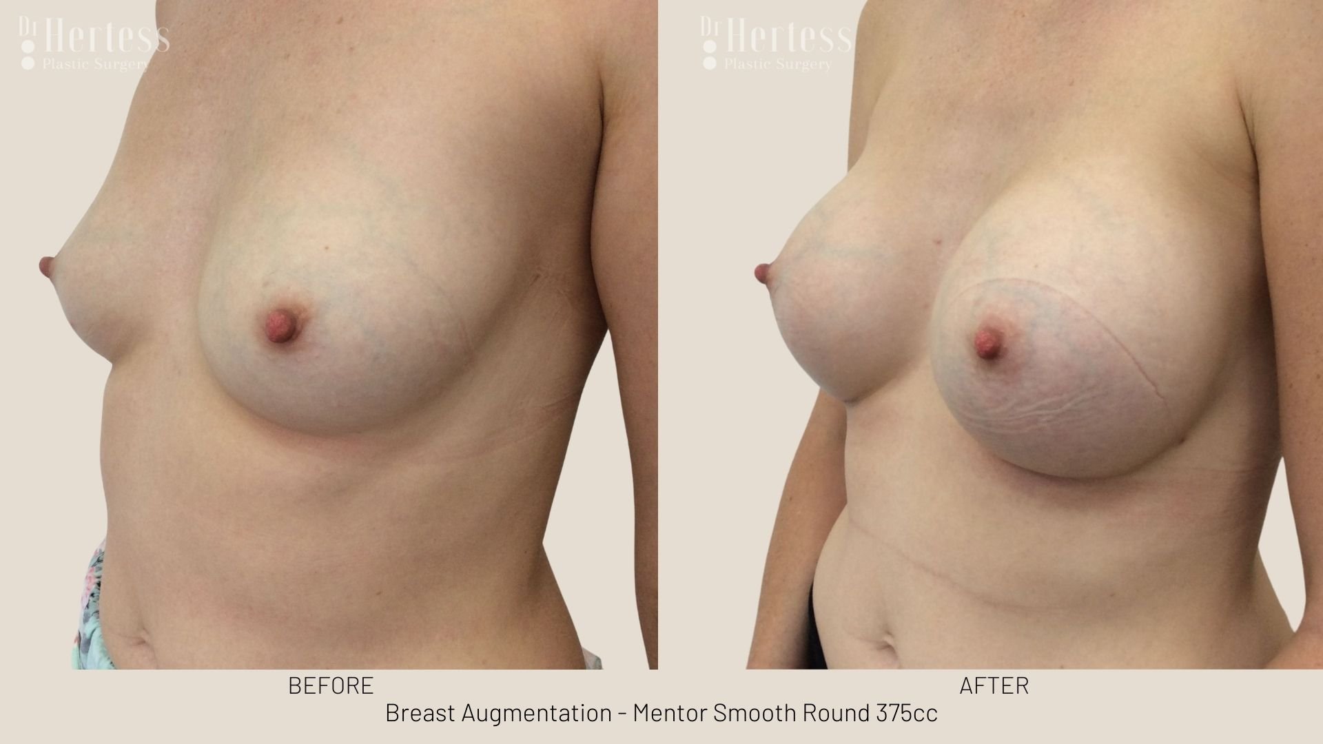 breast aug before and after