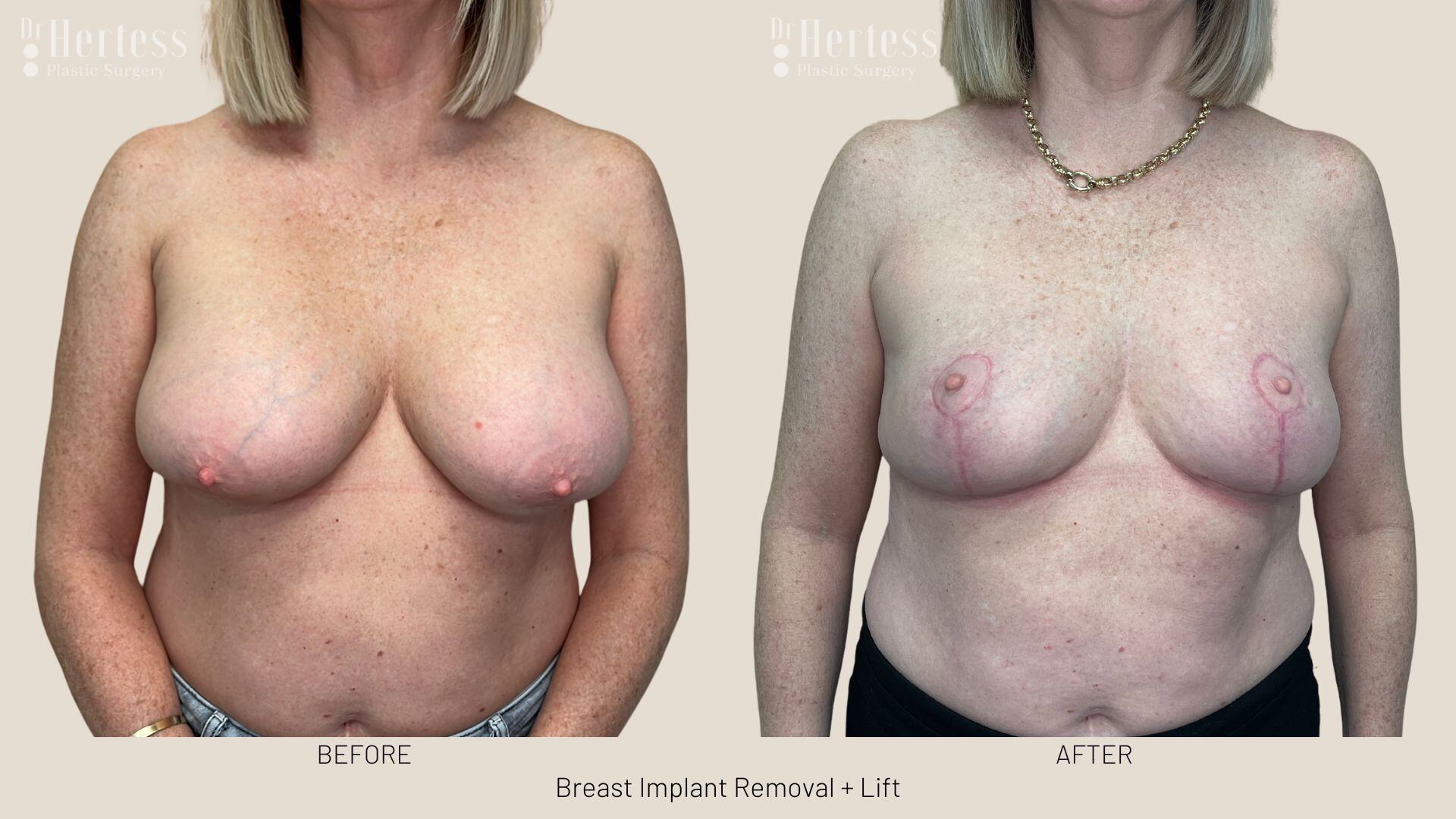 breast implant removal and lift before and after