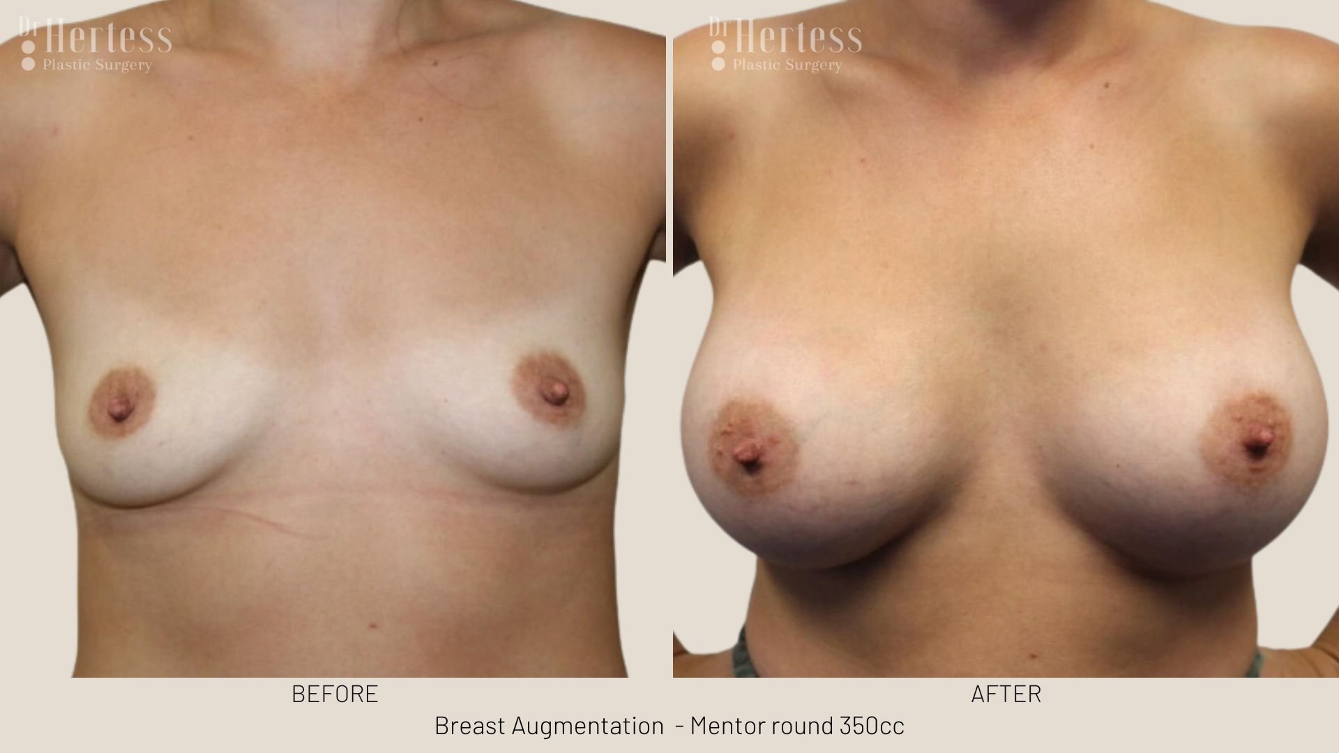 breast augmentation before and after