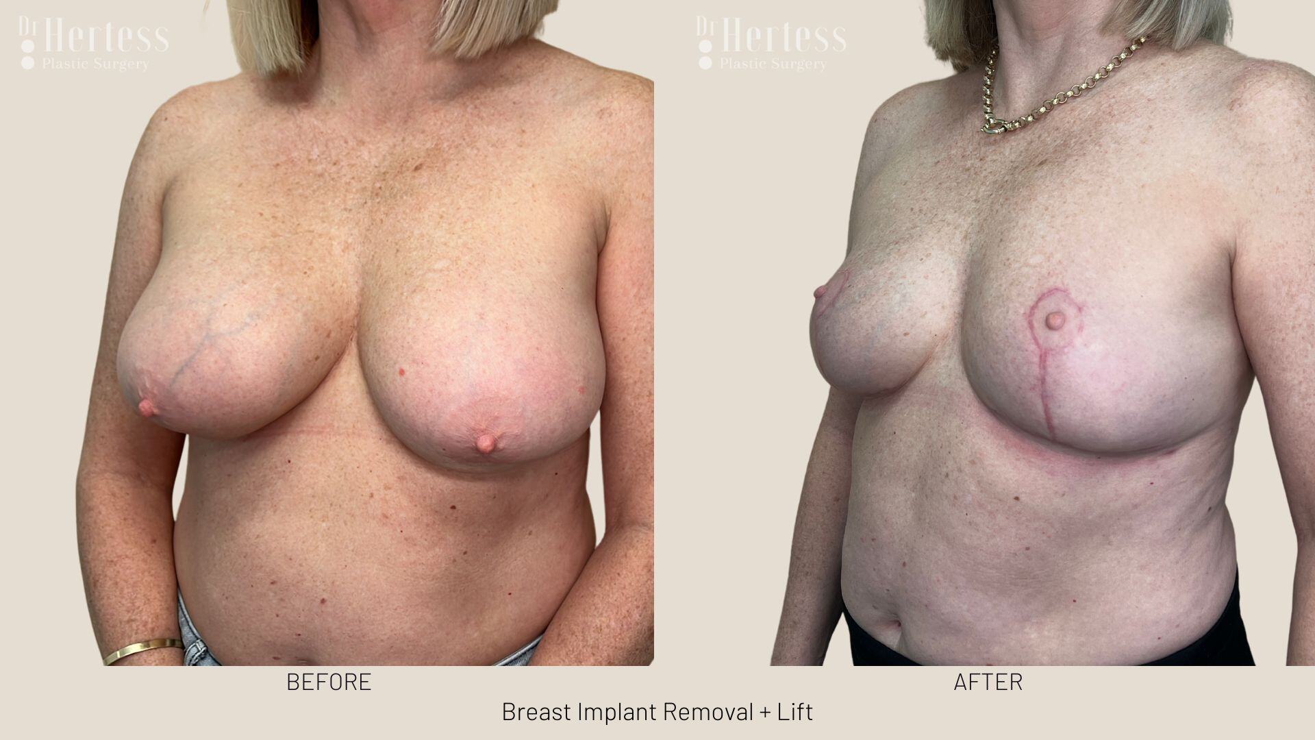 breast implant removal and lift before and after