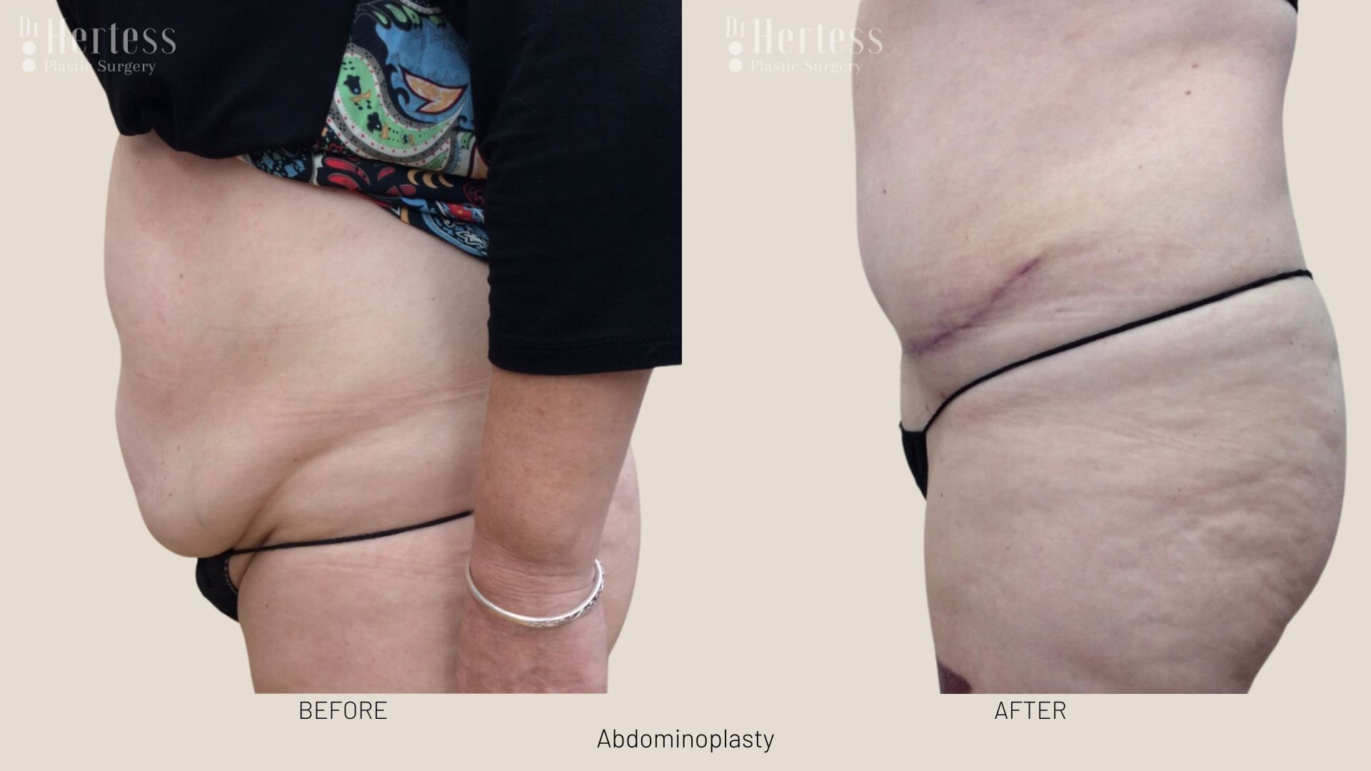 tummy tuck scars before and after