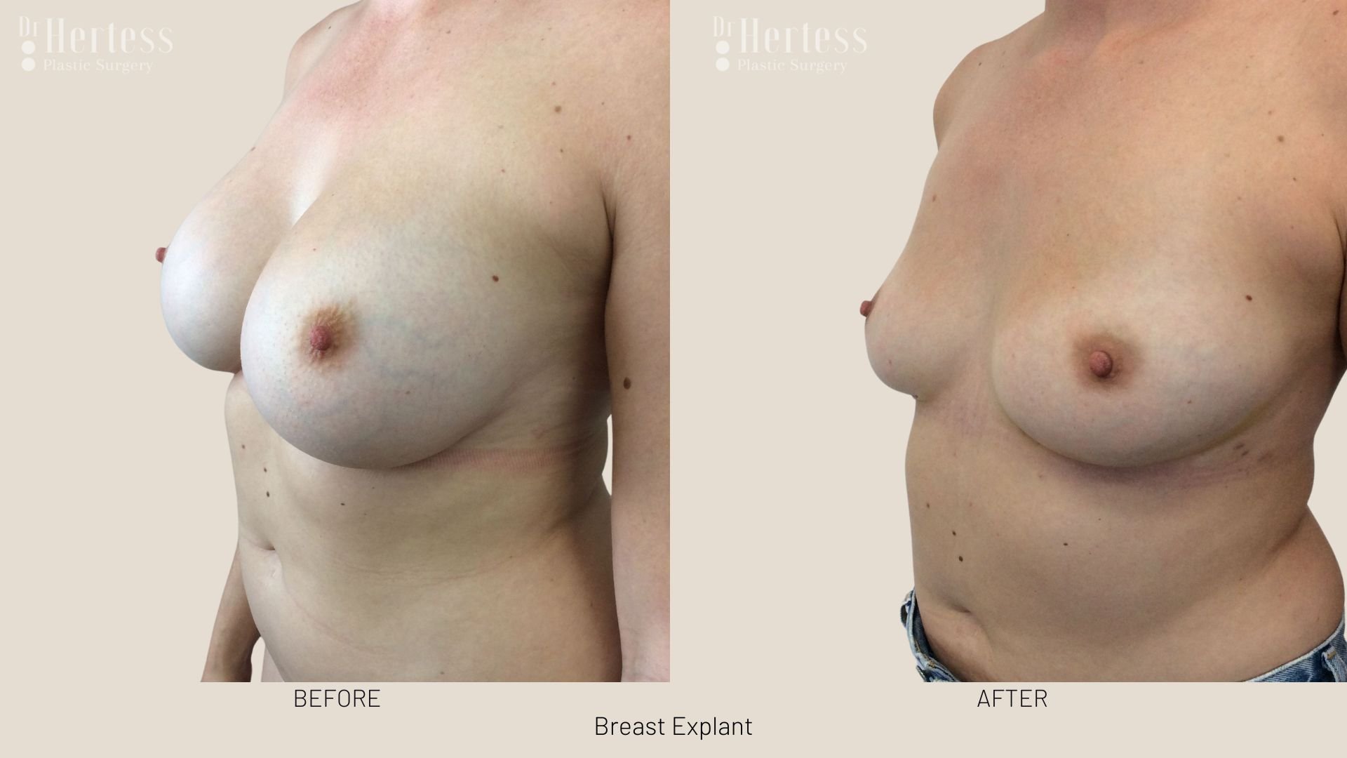 breast implant removal