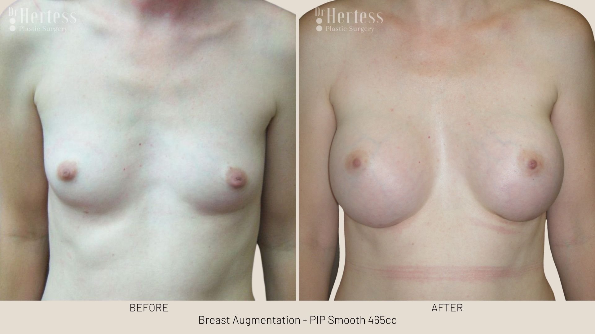 breast aug before and after