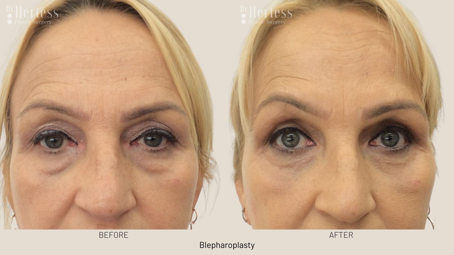 eyelid lift photos