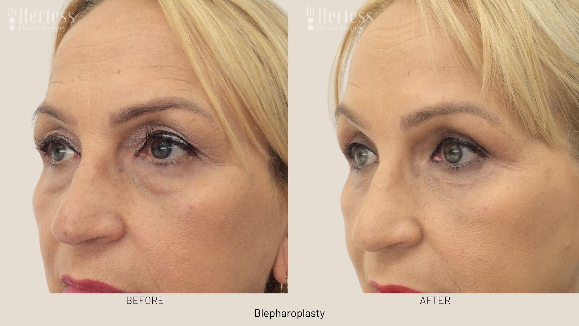 eyelid lift photos