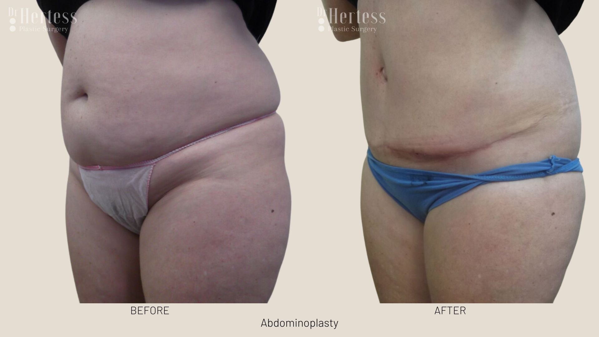 tummy tuck scars before and after