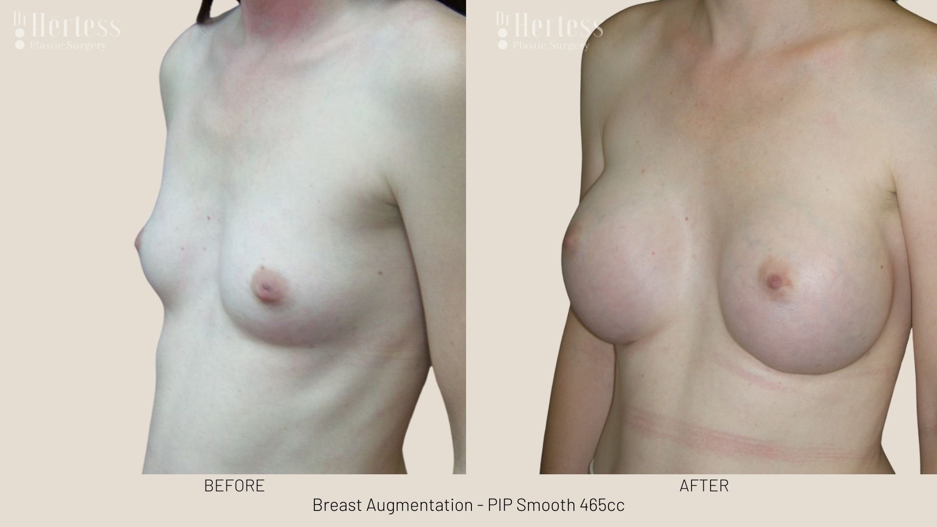 breast aug before and after