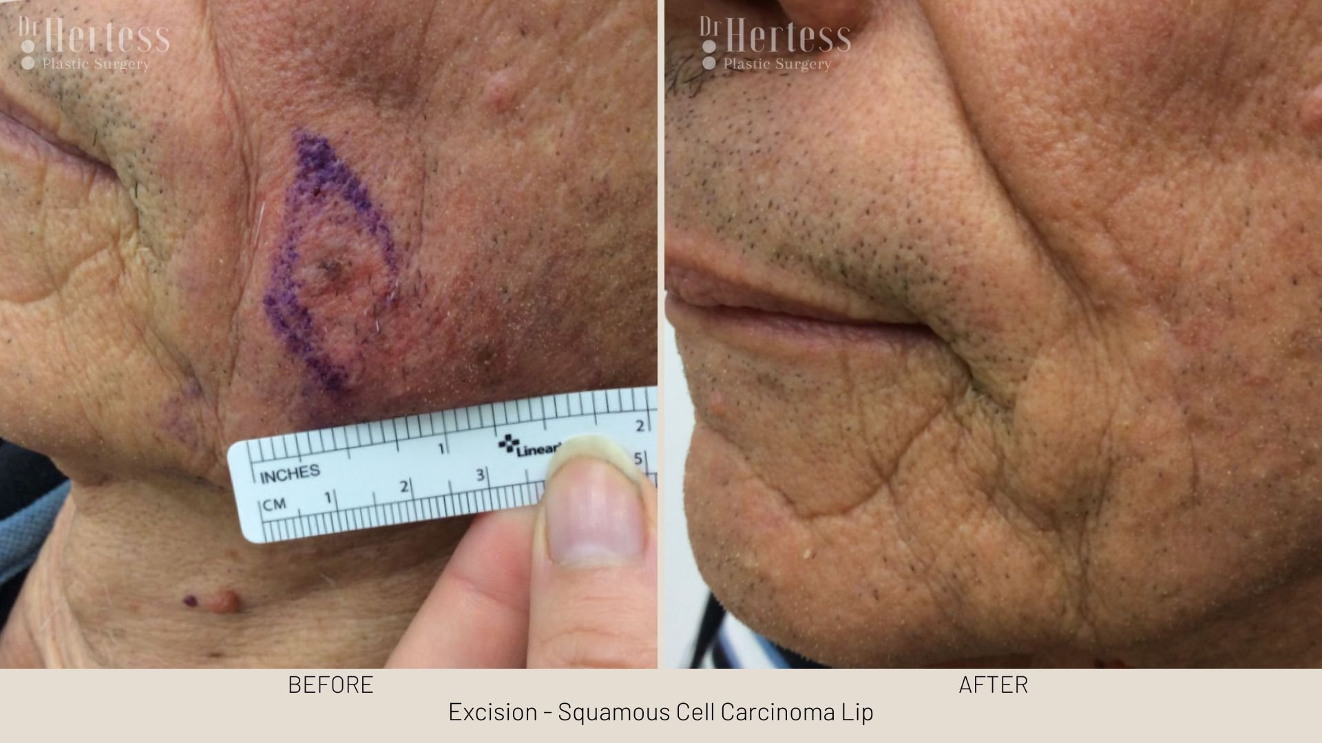 skin cancer removal