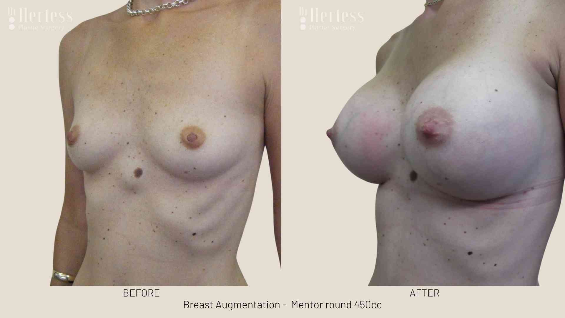 breast enhancement before and after