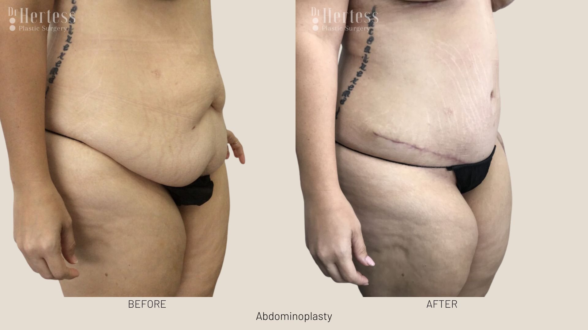 tummy tuck scars before and after