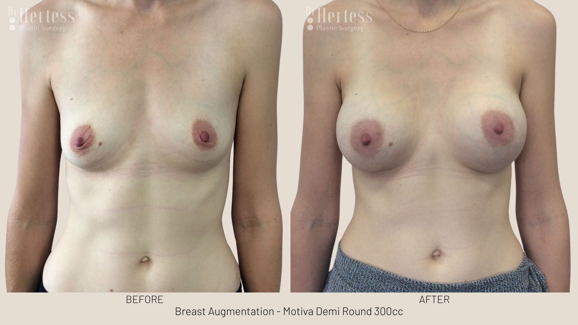 breast aug before and after