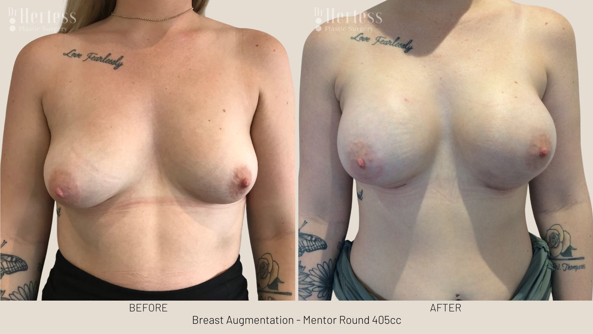 boob job before and after