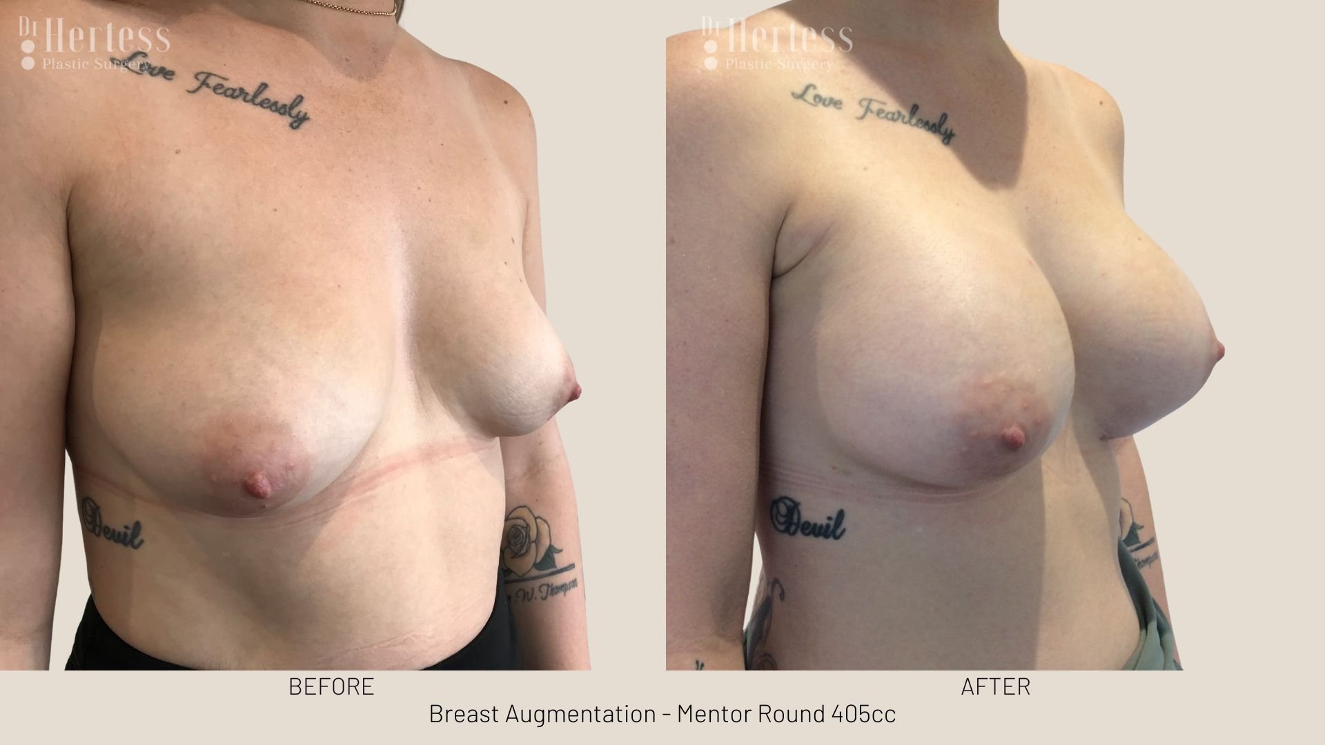 boob job before and after