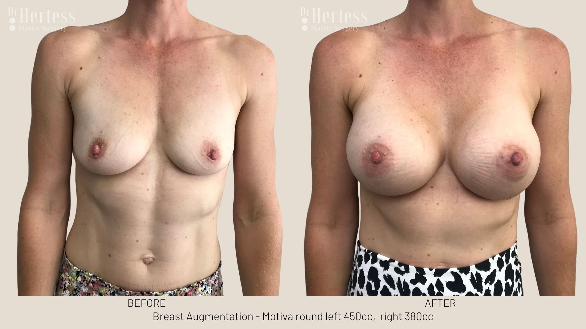 breast implants before and after pictures