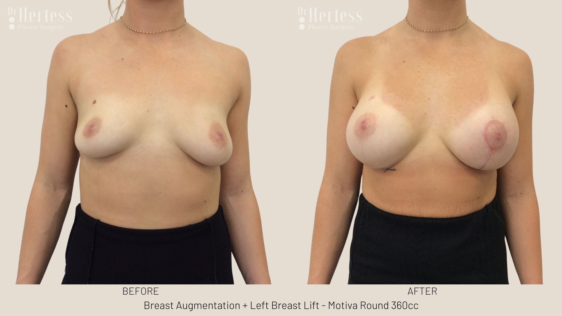 breast lift before and afters