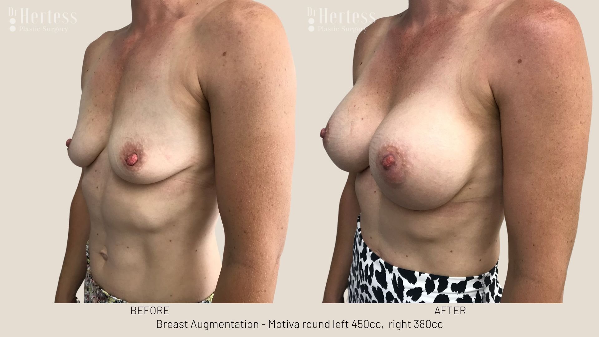 breast job before and after