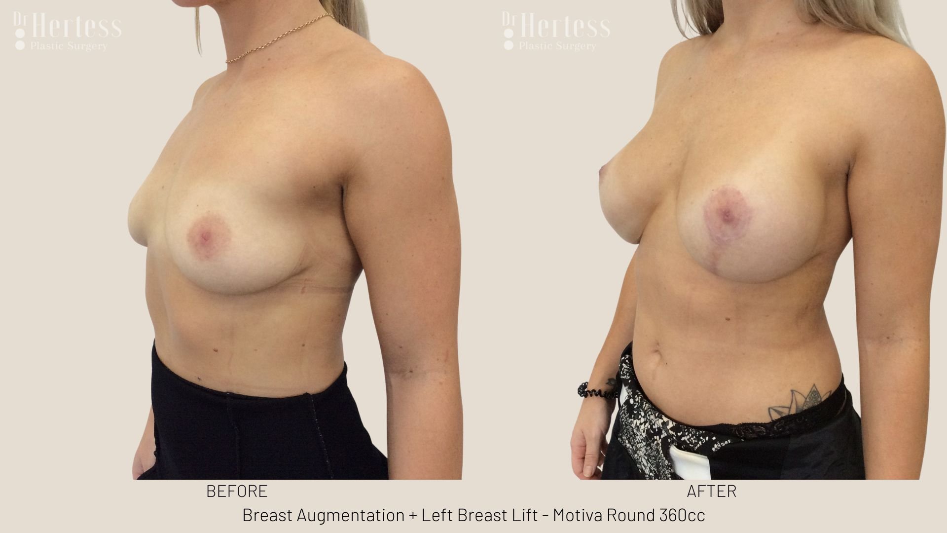 breast lift and augmentation before and after