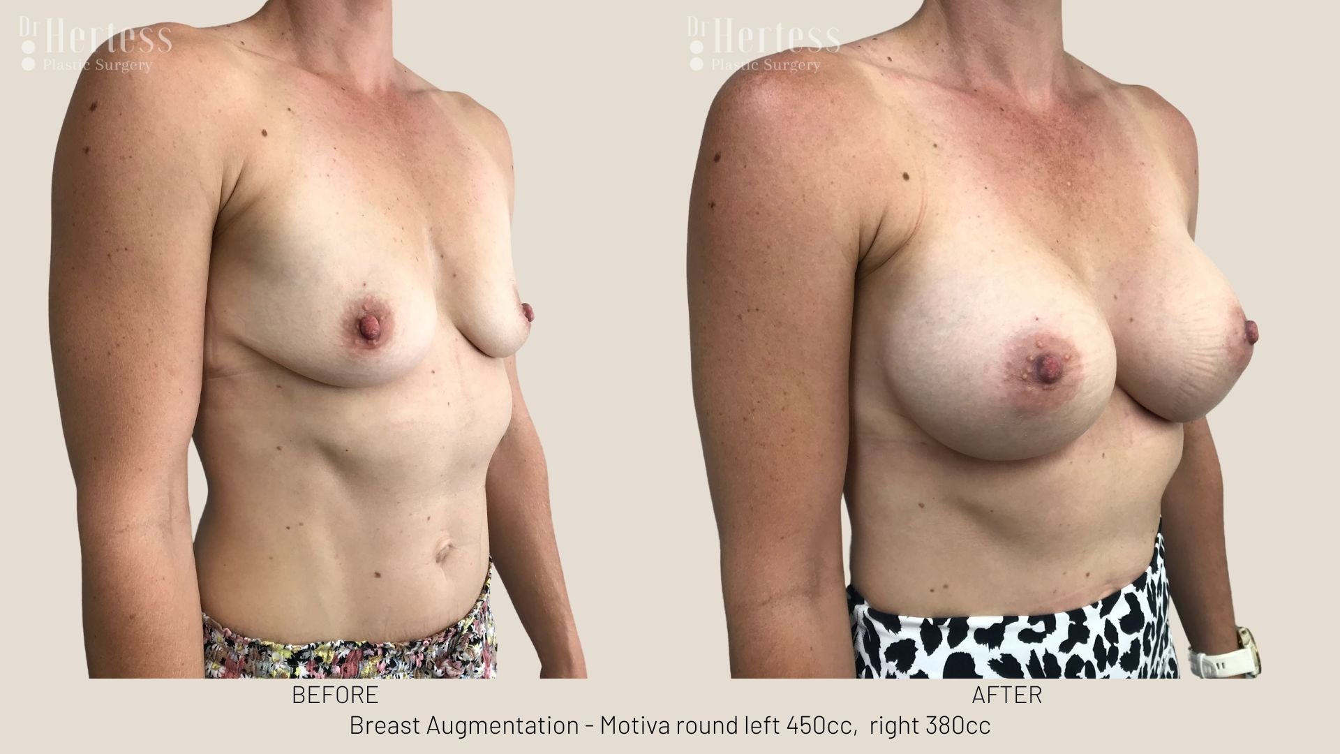 breast implants before and after pictures