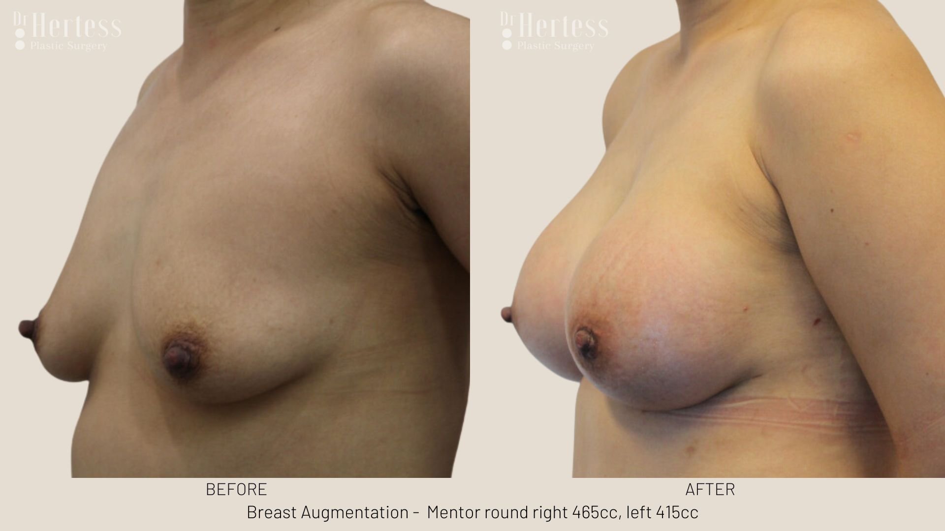 breast job before and after