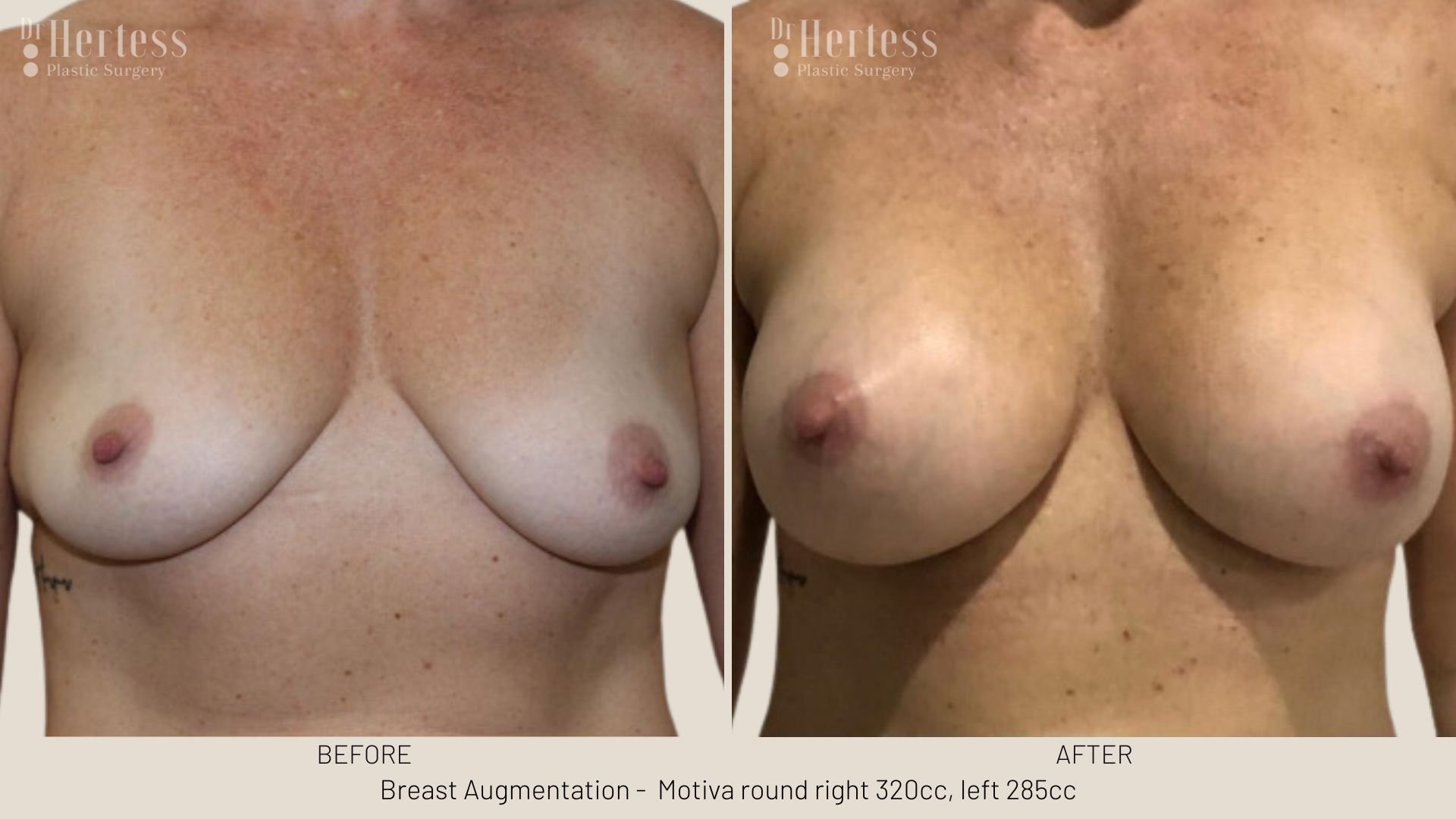 before and after augmentation