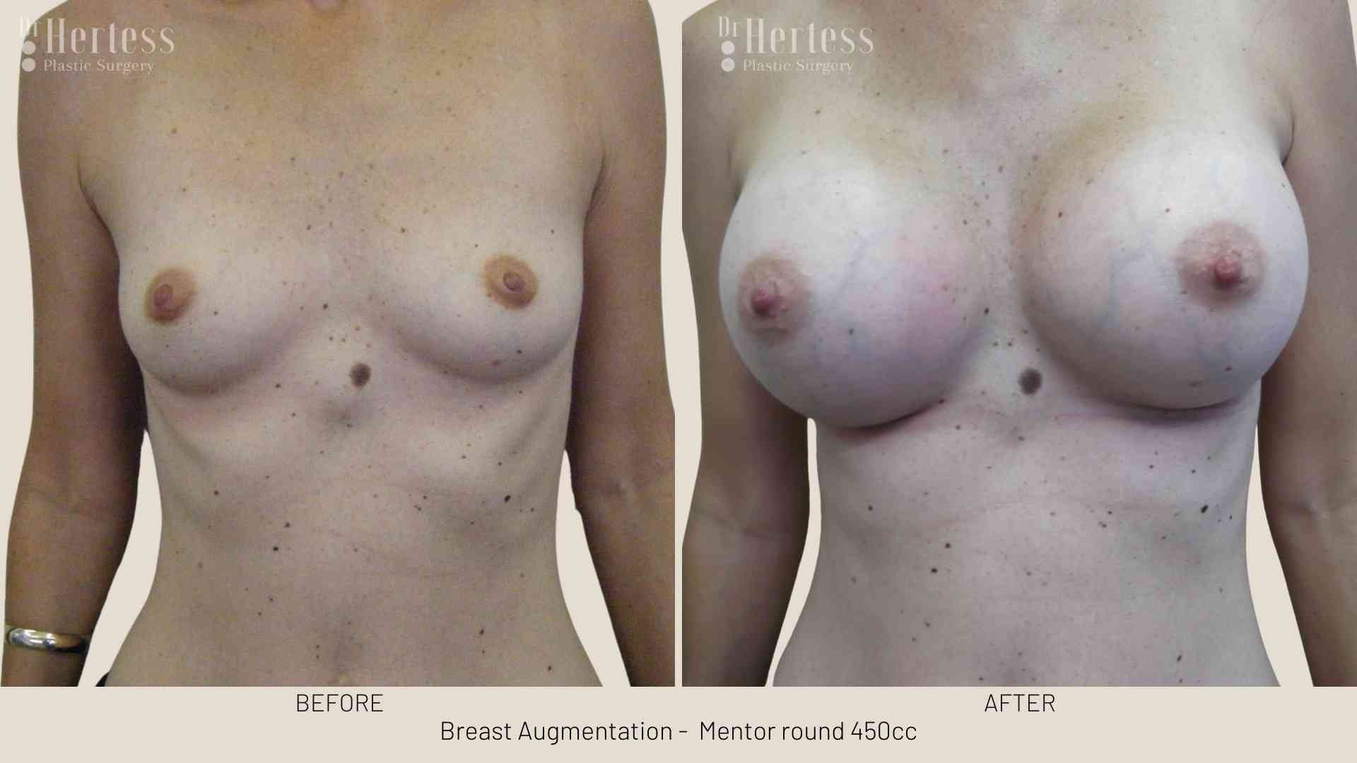 breast enhancement before and after