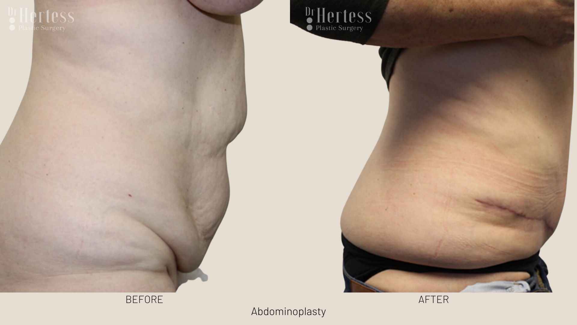 tummy tuck scars before and after