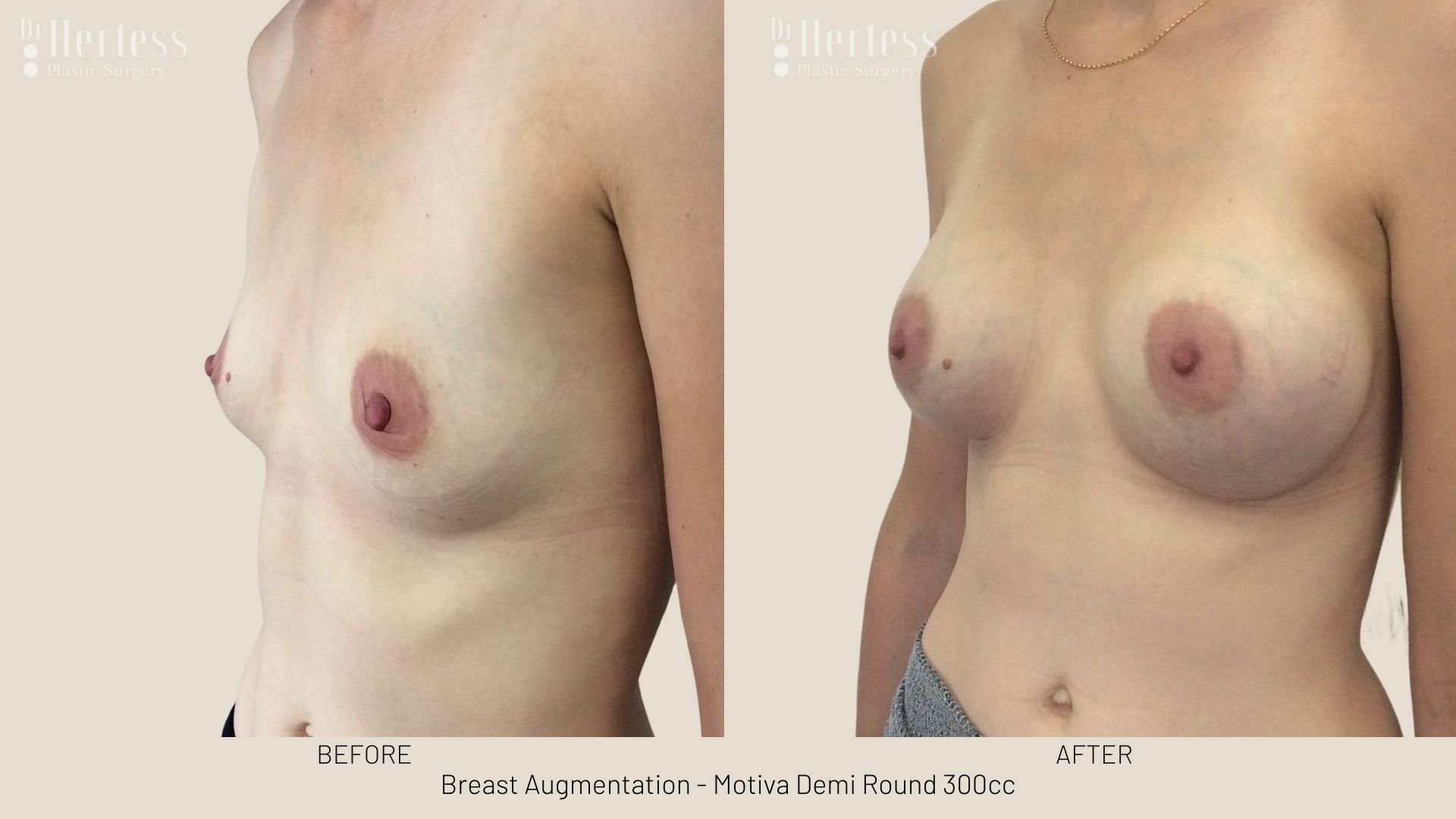 breast aug before and after