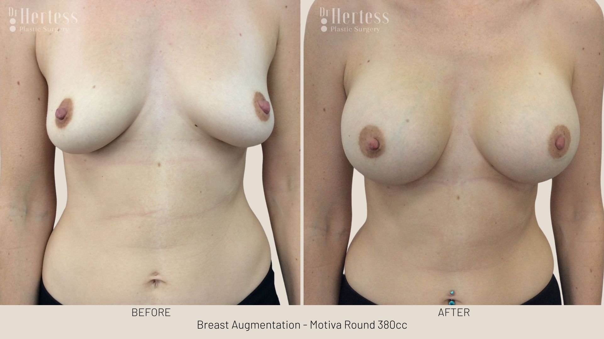 breast augmentation before and after