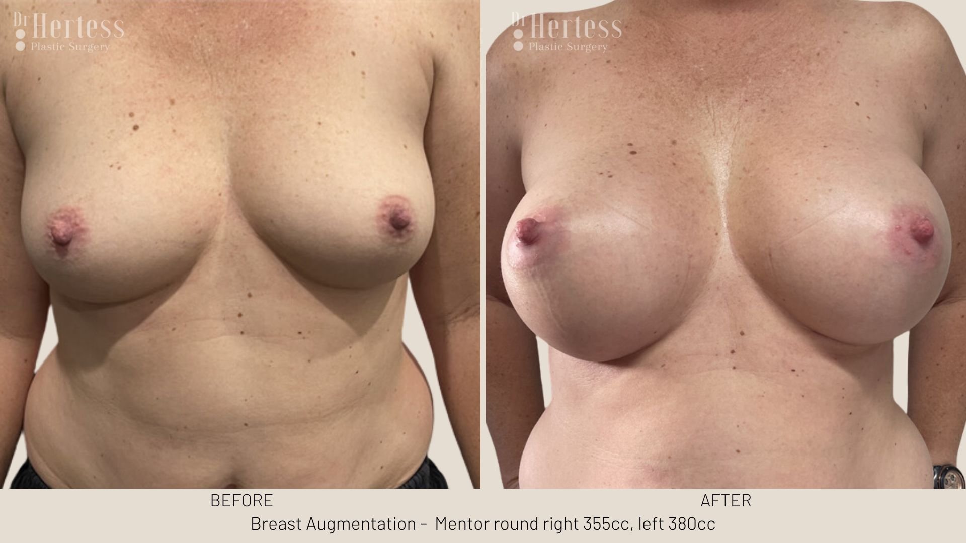 before and after augmentation