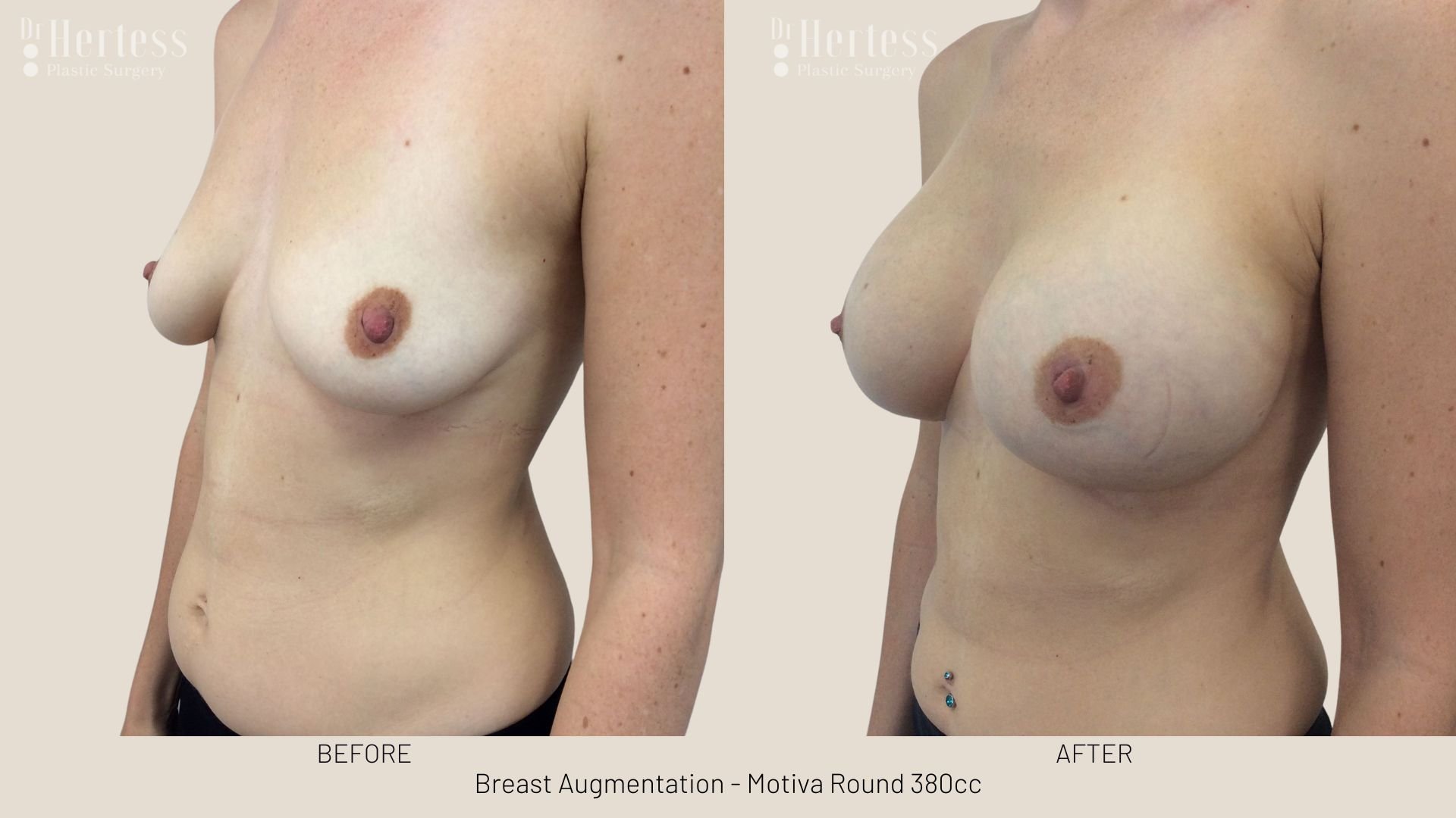 breast augmentation before and after