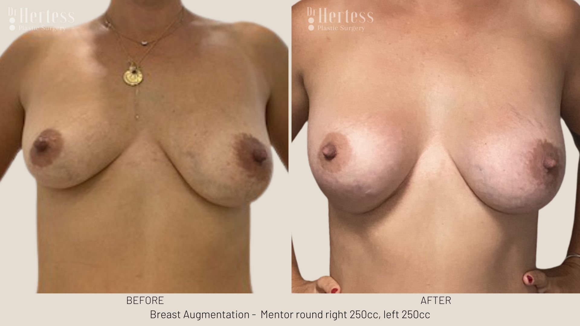 breast job before and after