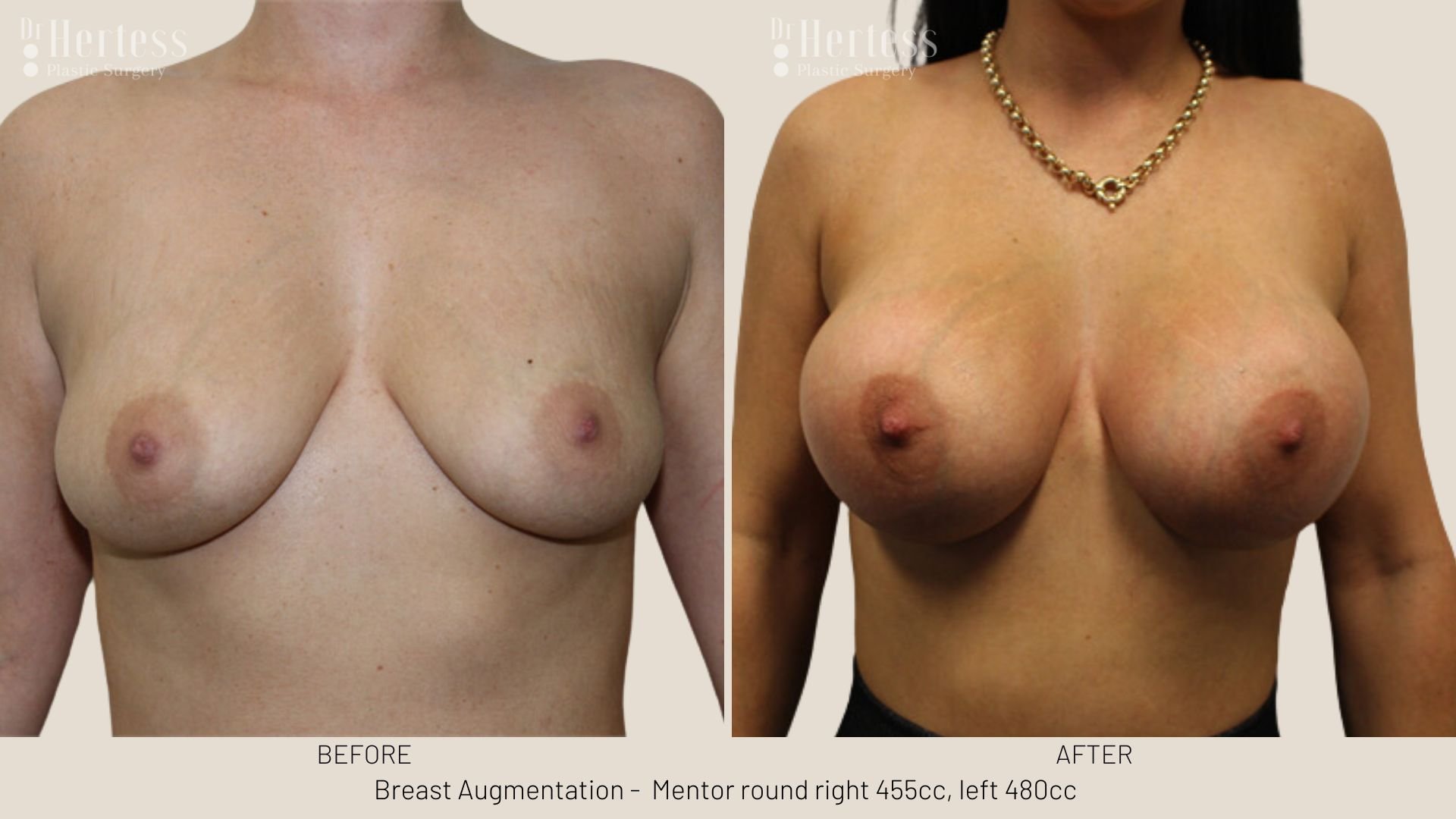 breast job before and after