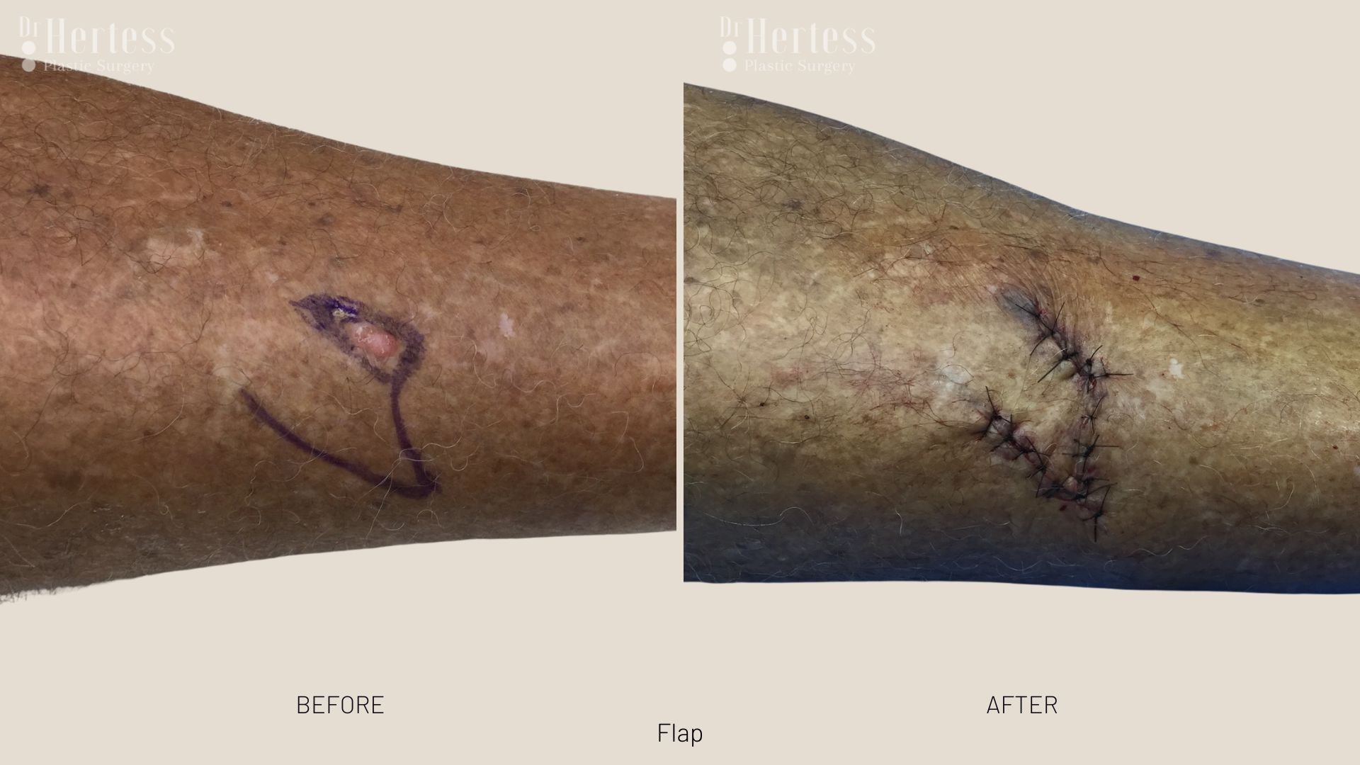 treatment for basal cell carcinoma