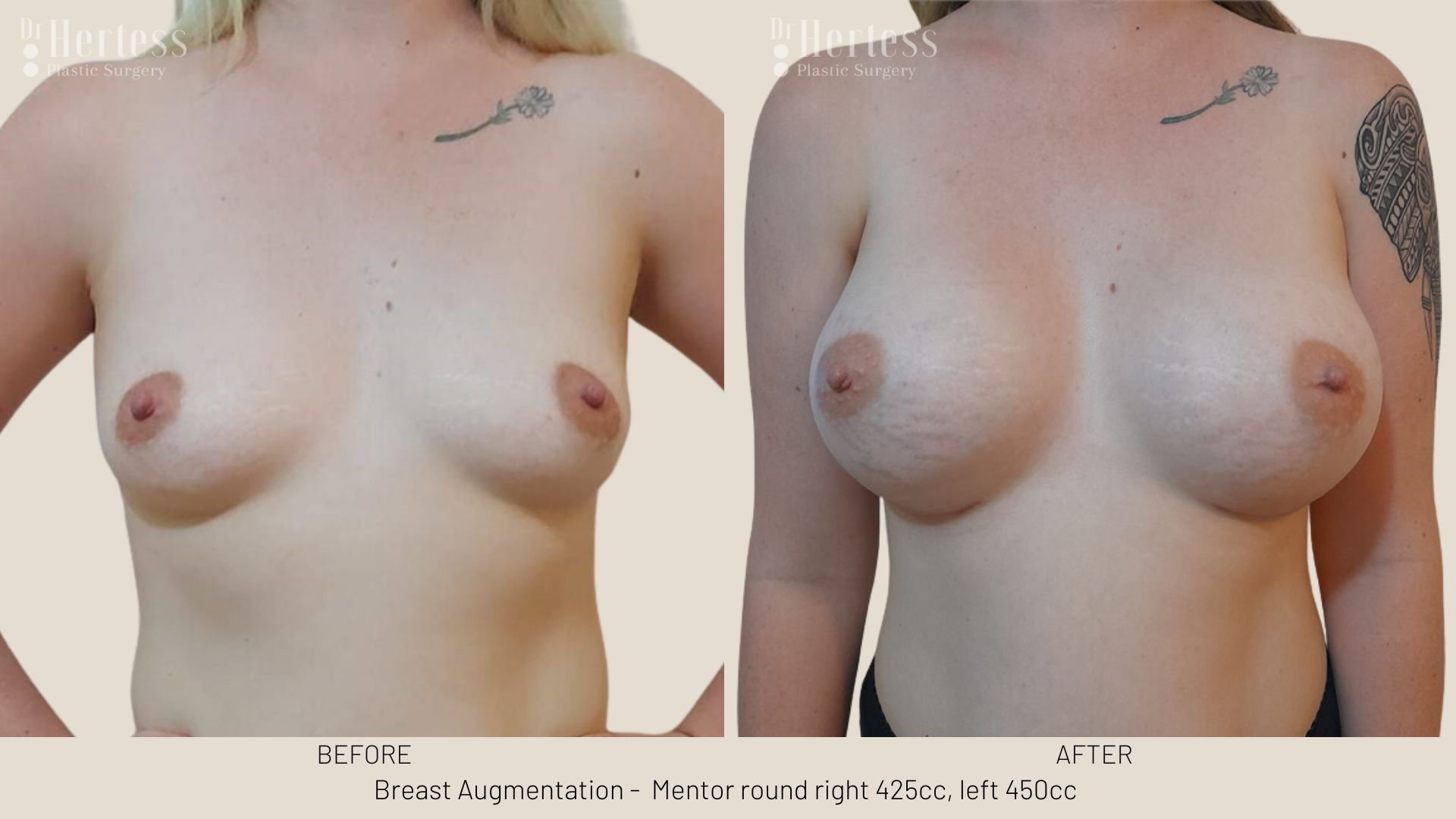 before and after augmentation