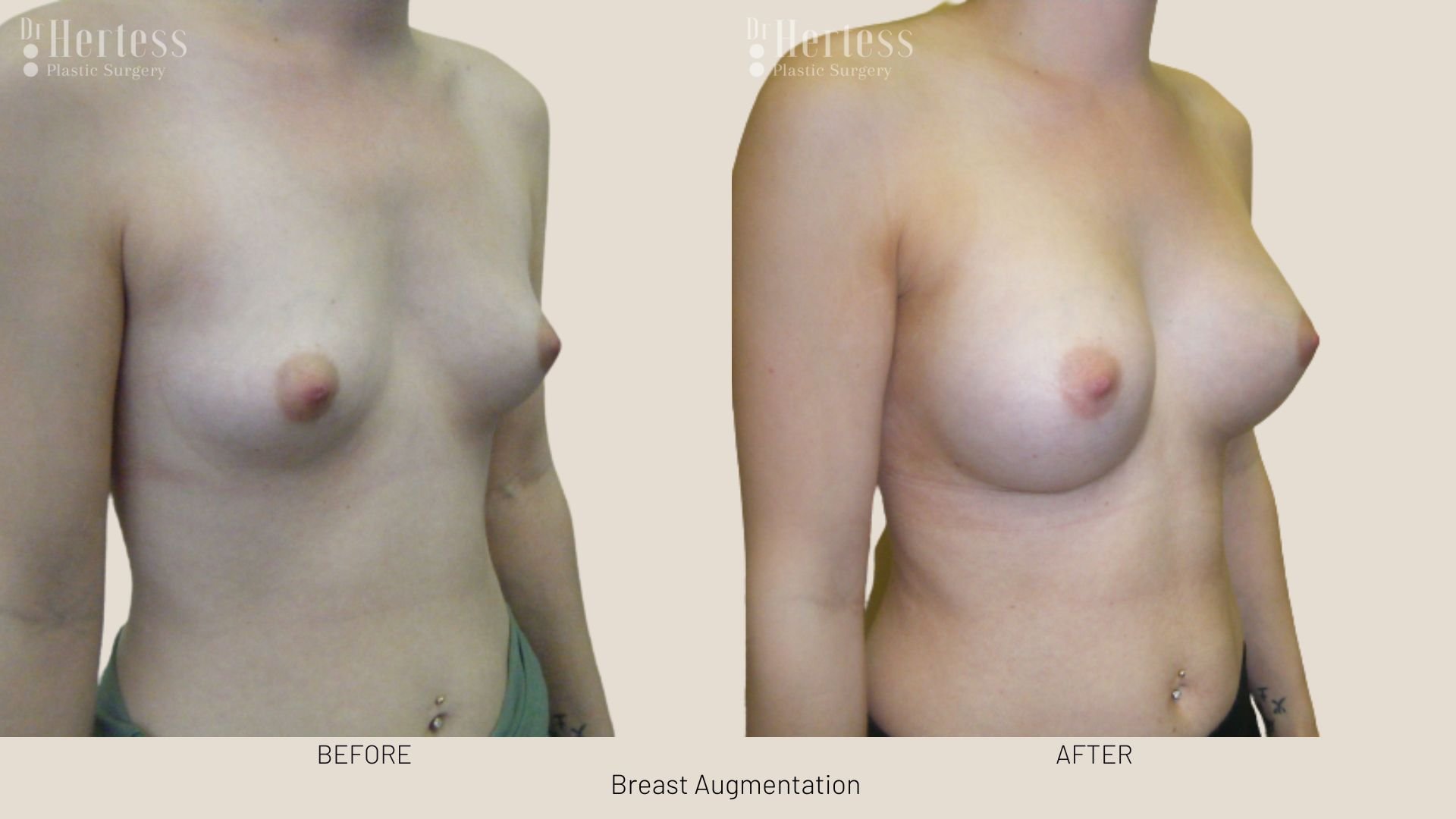 breast enlargement before after