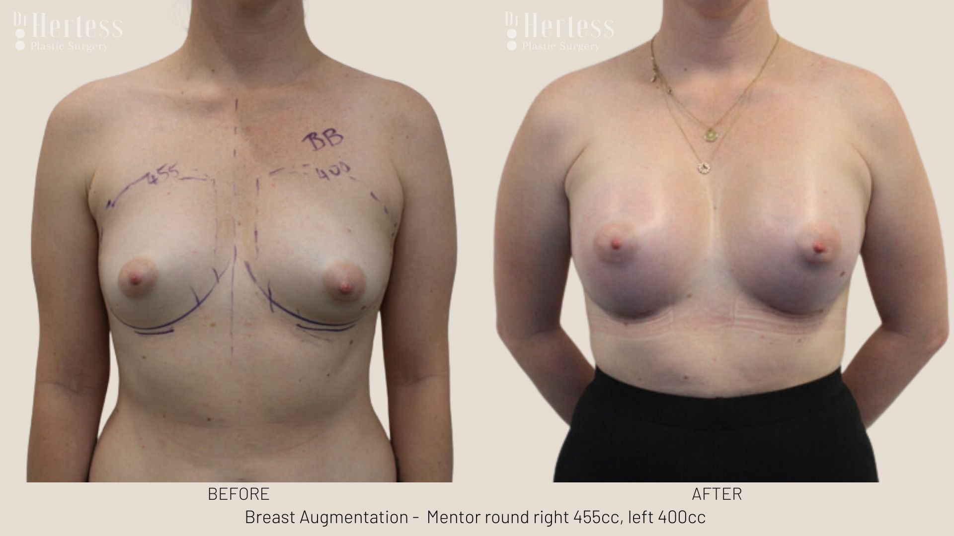 before and after augmentation