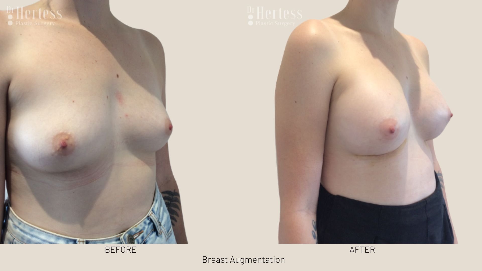 breast enlargement before after