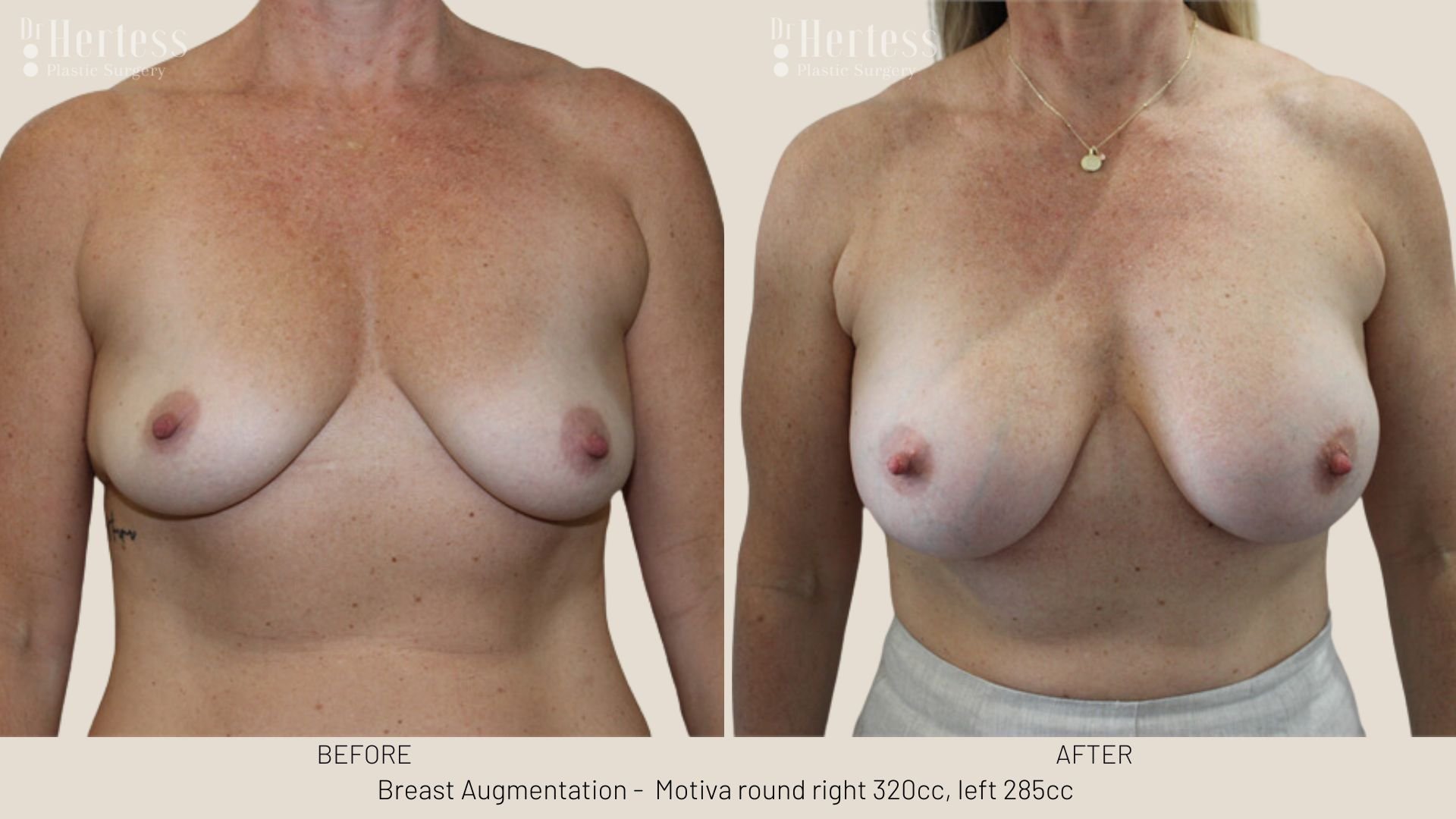 before and after augmentation