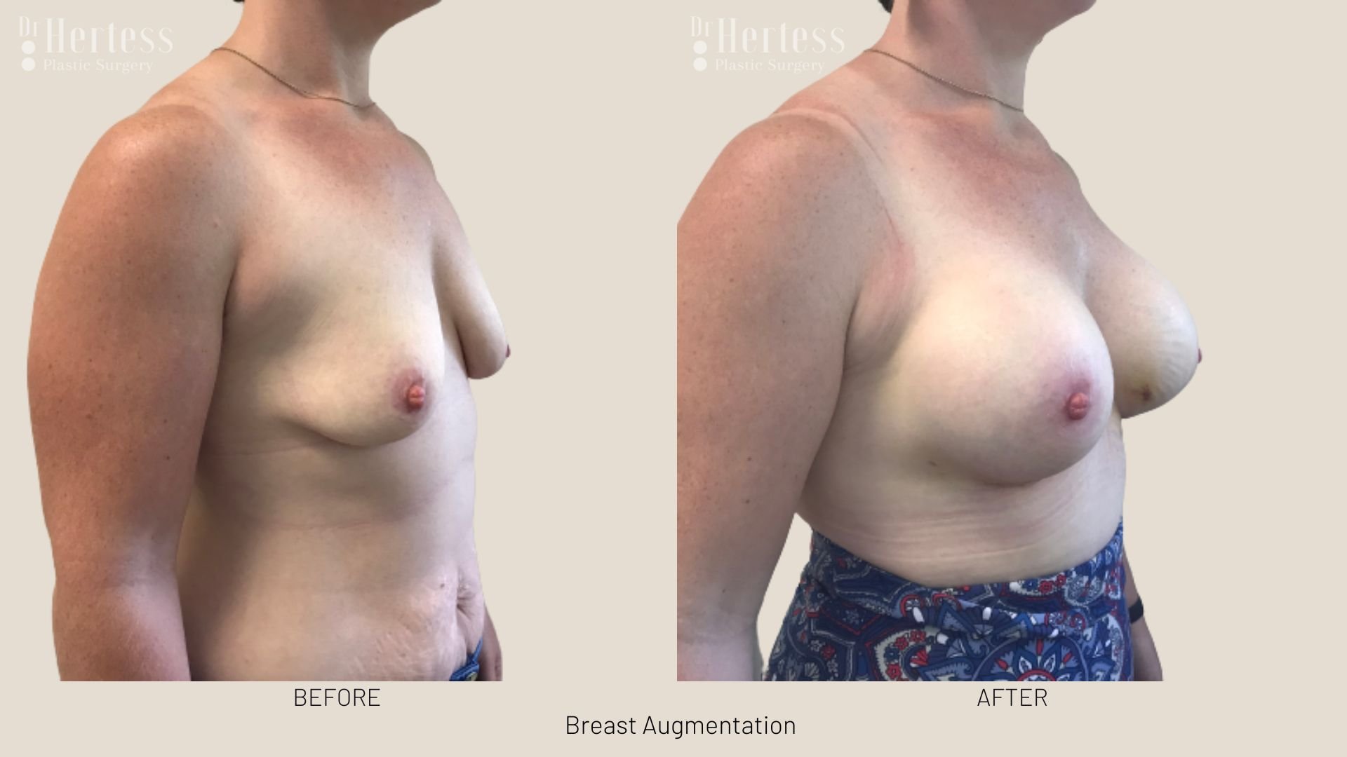 breast enlargement before after
